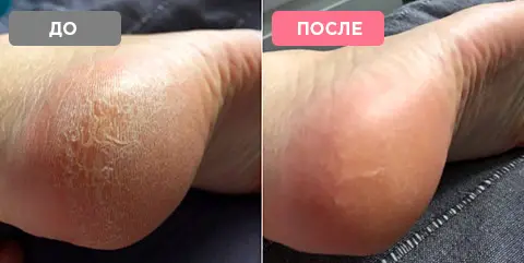 Електрична пемза-пилка для ніг Pedi Vac Прилад для видалення мозолів з вакуумним пилососом акумулятор USB - Зображення 7