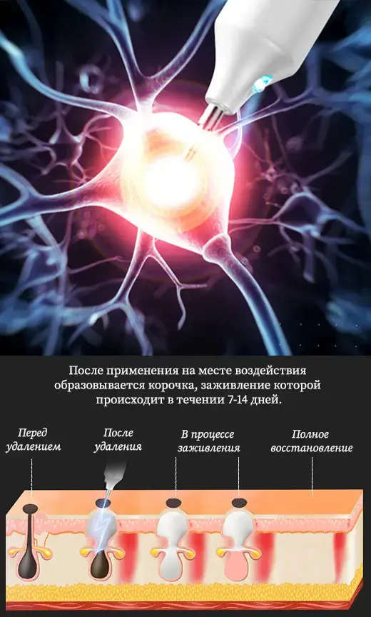 Коагулятор плазмовий, Plasma Pen/Електрокоагулятор/Бездротова ручка для видалення папілом та бородавок - Зображення 5